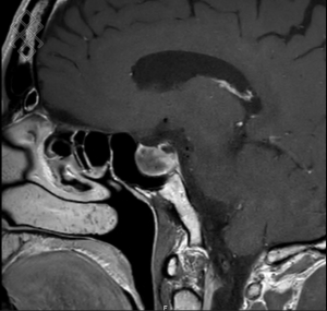 IRM de l’Hypophyse