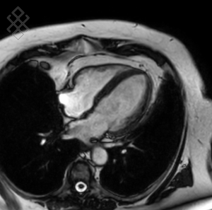 IRM Cardiaque de stress