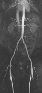 Angio-IRM Abdominale