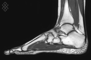 IRM du Pied/Avant-pied