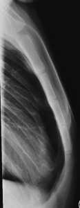 Radiographie du Sternum