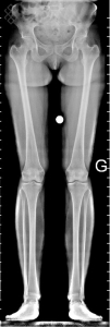 TéléRadiographie des Membres Inférieurs