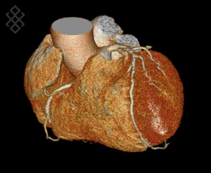 Scanner Cardiaque