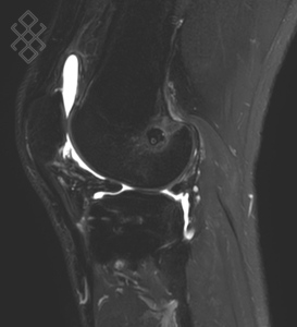 Arthro-IRM du Genou