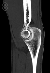 Protocol - Arthroscanner du Coude