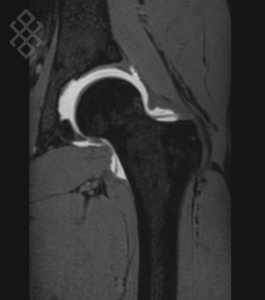 Arthro-IRM de la Hanche