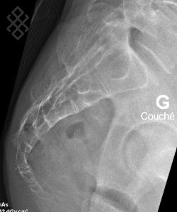 Radiographie du Coccyx