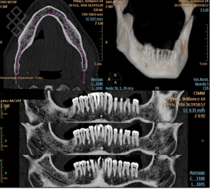 Scanner Dentaire (Dentascan)