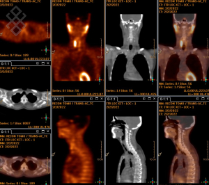 Scintigraphie des Parathyroïdes