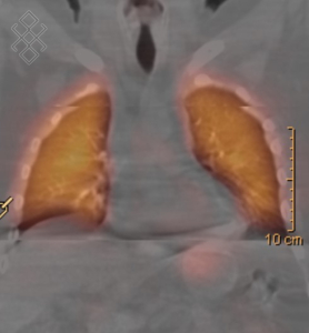 Scintigraphie Pulmonaire