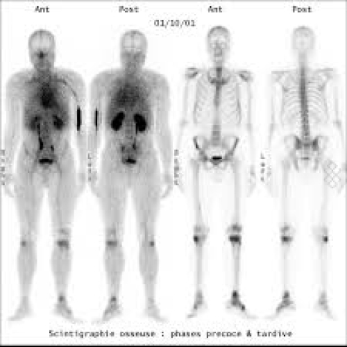 Déroulement Scintigraphy
